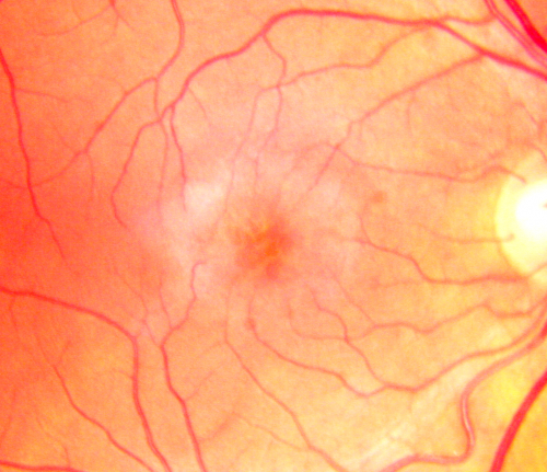 Idiopathic Cystoid Macular Edema - CME - Responded to Subtenons Kenalog - Color Photo Showing Foveal Cysts
49-year-old man had a flu two weeks ago the right eye has been throbbing and his vision in the right eye has been foggy.  OD 20/80, OS 20/40.   IOP:  14 OU.  

Mots-clés: cme;cystoid macular edema;steroids;idiopathic