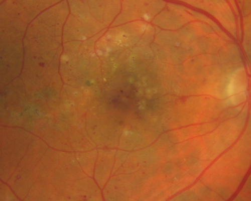 BDR and Diabetic Macular Edema with Fresh Laser Right Eye
60-year old man OD 20/60, OS 20/50 worsening vision both eyes
