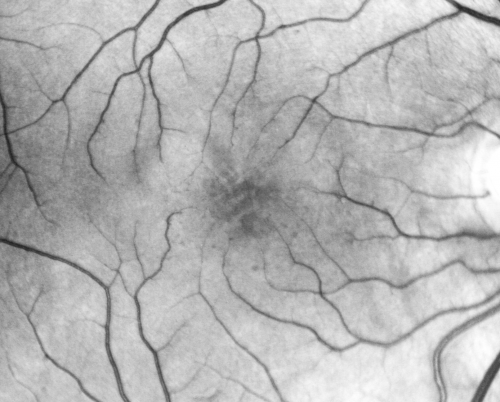 Idiopathic Cystoid Macular Edema - CME - Responded to Subtenons Kenalog - Red Free Photos Shows Foveal Cysts
49-year-old man had a flu two weeks ago the right eye has been throbbing and his vision in the right eye has been foggy.  OD 20/80, OS 20/40.   IOP:  14 OU.  

Schlüsselwörter: cme;cystoid macular edema;steroids;idiopathic