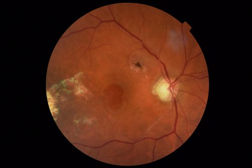Macular Damage post Macular Hole Surgery
There is a huge hole in the middle of the macula and several small holes in the posterior pole.  The patient had 2 surgeries for an idiopathic stage II hole and then was offered a third procedure by the same surgeon and sought a second opinion (and was told to not have anything more done)
