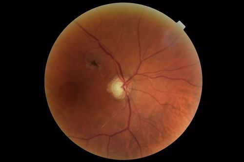 Macular Damage post Macular Hole Surgery
There is a huge hole in the middle of the macula and several small holes in the posterior pole.  The patient had 2 surgeries for an idiopathic stage II hole and then was offered a third procedure by the same surgeon and sought a second opinion (and was told to not have anything more done)
