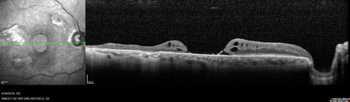 Macular Damage post Macular Hole Surgery
There is a huge hole in the middle of the macula and several small holes in the posterior pole.  The patient had 2 surgeries for an idiopathic stage II hole and then was offered a third procedure by the same surgeon and sought a second opinion (and was told to not have anything more done)
