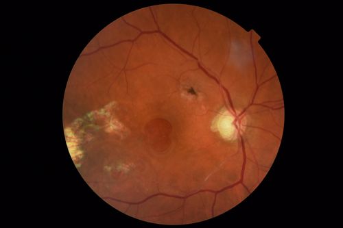 Macular Damage post Macular Hole Surgery
There is a huge hole in the middle of the macula and several small holes in the posterior pole.  The patient had 2 surgeries for an idiopathic stage II hole and then was offered a third procedure by the same surgeon and sought a second opinion (and was told to not have anything more done)
