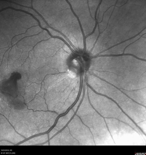 Valsalva Retinopathy - Macular Hemorrhage - Permanent Vision loss - Intraretinal Blood
65 year old man with sudden vision loss in the right eye. Initial vision 20/200.  VA improved to 20/50 in one year.  Had carotid stenosis
