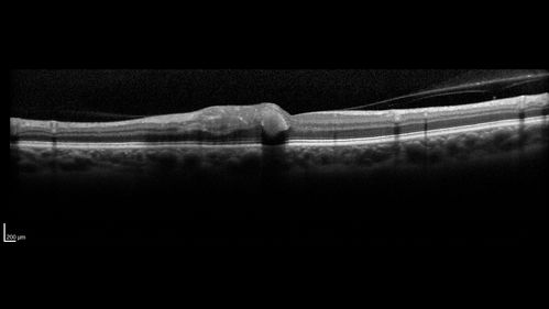 Valsalva Retinopathy - Macular Hemorrhage - Permanent Vision loss - Intraretinal Blood
65 year old man with sudden vision loss in the right eye. Initial vision 20/200.  VA improved to 20/50 in one year.  Had carotid stenosis
