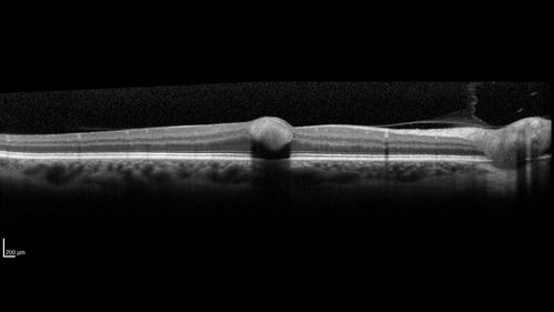 Valsalva Retinopathy - Macular Hemorrhage - Permanent Vision loss - Intraretinal Blood
65 year old man with sudden vision loss in the right eye. Initial vision 20/200.  VA improved to 20/50 in one year.  Had carotid stenosis
