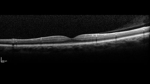 Valsalva Retinopathy - Macular Hemorrhage - Permanent Vision loss - Intraretinal Blood
65 year old man with sudden vision loss in the right eye. Initial vision 20/200.  VA improved to 20/50 in one year.  Had carotid stenosis
