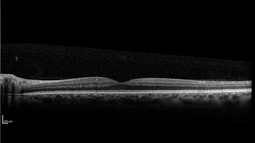 Normal Left eye
Left eye of patient with valsalva retinopathy in the right
