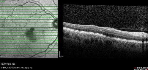 Valsalva Retinopathy - Macular Hemorrhage - Permanent Vision loss - Intraretinal Blood
65 year old man with sudden vision loss in the right eye. Initial vision 20/200.  VA improved to 20/50 in one year.  Had carotid stenosis
