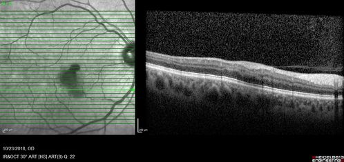 Valsalva Retinopathy - Macular Hemorrhage - Permanent Vision loss - Intraretinal Blood
65 year old man with sudden vision loss in the right eye. Initial vision 20/200.  VA improved to 20/50 in one year.  Had carotid stenosis

