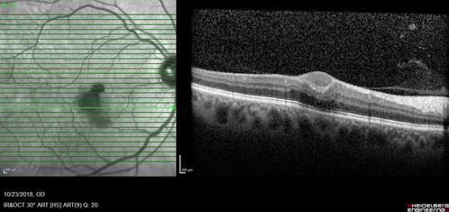 Valsalva Retinopathy - Macular Hemorrhage - Permanent Vision loss - Intraretinal Blood
65 year old man with sudden vision loss in the right eye. Initial vision 20/200.  VA improved to 20/50 in one year.  Had carotid stenosis
