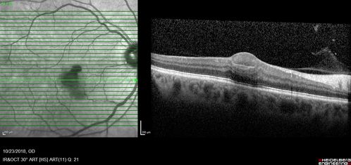 Valsalva Retinopathy - Macular Hemorrhage - Permanent Vision loss - Intraretinal Blood
65 year old man with sudden vision loss in the right eye. Initial vision 20/200.  VA improved to 20/50 in one year.  Had carotid stenosis
