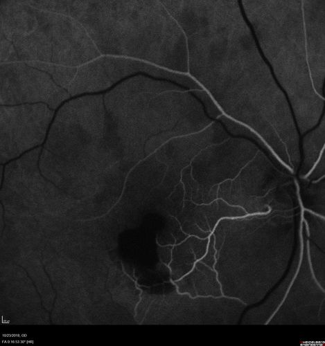 Valsalva Retinopathy - Macular Hemorrhage - Permanent Vision loss - Intraretinal Blood
65 year old man with sudden vision loss in the right eye. Initial vision 20/200.  VA improved to 20/50 in one year.  Had carotid stenosis
