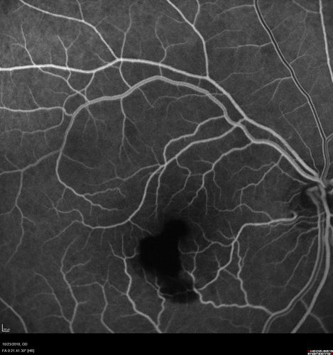 Valsalva Retinopathy - Macular Hemorrhage - Permanent Vision loss - Intraretinal Blood
65 year old man with sudden vision loss in the right eye. Initial vision 20/200.  VA improved to 20/50 in one year.  Had carotid stenosis
