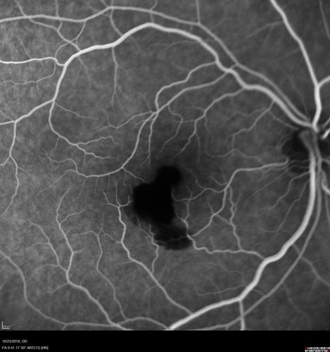 Valsalva Retinopathy - Macular Hemorrhage - Permanent Vision loss - Intraretinal Blood
65 year old man with sudden vision loss in the right eye. Initial vision 20/200.  VA improved to 20/50 in one year.  Had carotid stenosis
