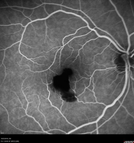 Valsalva Retinopathy - Macular Hemorrhage - Permanent Vision loss - Intraretinal Blood
65 year old man with sudden vision loss in the right eye. Initial vision 20/200.  VA improved to 20/50 in one year.  Had carotid stenosis
