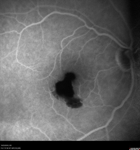 Valsalva Retinopathy - Macular Hemorrhage - Permanent Vision loss - Intraretinal Blood
65 year old man with sudden vision loss in the right eye. Initial vision 20/200.  VA improved to 20/50 in one year.  Had carotid stenosis
