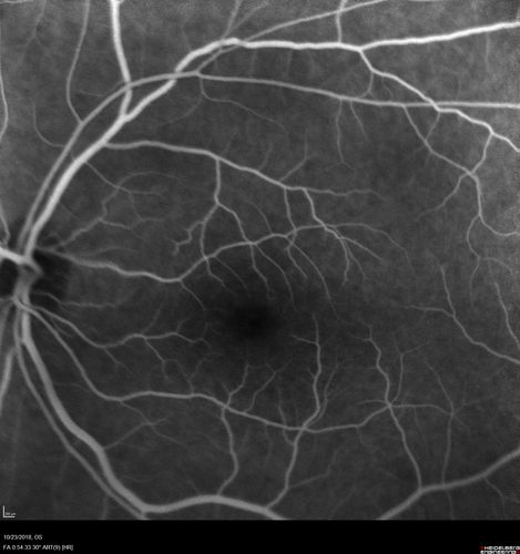 Valsalva Retinopathy - Macular Hemorrhage - Permanent Vision loss - Intraretinal Blood
65 year old man with sudden vision loss in the right eye. Initial vision 20/200.  VA improved to 20/50 in one year.  Had carotid stenosis

