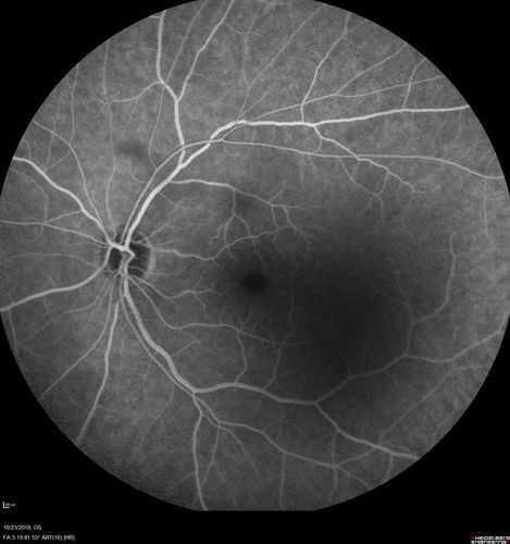 Valsalva Retinopathy - Macular Hemorrhage - Permanent Vision loss - Intraretinal Blood
65 year old man with sudden vision loss in the right eye. Initial vision 20/200.  VA improved to 20/50 in one year.  Had carotid stenosis
