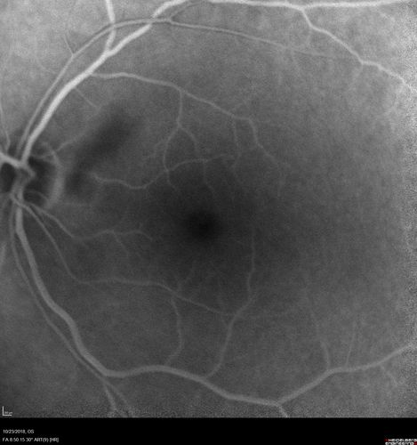Valsalva Retinopathy - Macular Hemorrhage - Permanent Vision loss - Intraretinal Blood
65 year old man with sudden vision loss in the right eye. Initial vision 20/200.  VA improved to 20/50 in one year.  Had carotid stenosis
