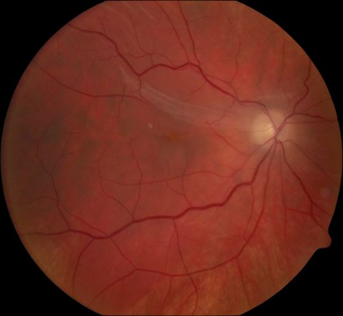Fresh Macular Fold following Macula On Superior Retinal Detachment Repair
Macular fold after pneumatic retinopexy for macula on superior retinal detachment.  Visual acuity is 20/200
