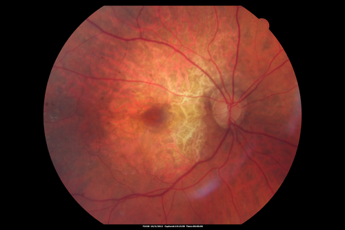 Posterior Polar Annular Choroidal Dystrophy
68 year old woman with know macular irregularities for over 20 years.  She has since been followed another 6 years and her vision remains 20/25.
