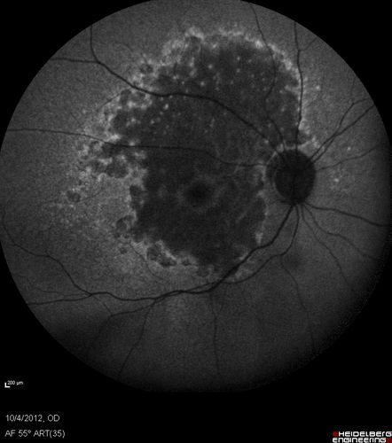 Posterior Polar Annular Choroidal Dystrophy
68 year old woman with know macular irregularities for over 20 years.  She has since been followed another 6 years and her vision remains 20/25.
