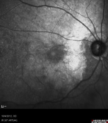 Posterior Polar Annular Choroidal Dystrophy
68 year old woman with know macular irregularities for over 20 years.  She has since been followed another 6 years and her vision remains 20/25.
