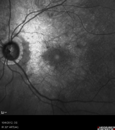 Posterior Polar Annular Choroidal Dystrophy
68 year old woman with know macular irregularities for over 20 years.  She has since been followed another 6 years and her vision remains 20/25.
