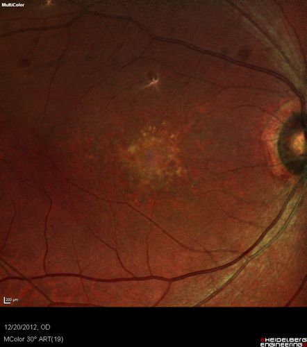Non-specific (uncharaterized / unknown) Macular Dystrophy 
59-year-old man has macular dystrophy in both eyes.  He had some vision changes in medical school in the 1980s and saw Dr. Gass for that.  He had some pigment epithelial irregularities in both eyes.  He had strabismus as a child and had muscle surgery.  He is color blind, along with many people in his family, and as far as he knows, it is congenital.
20/25, 20/30
