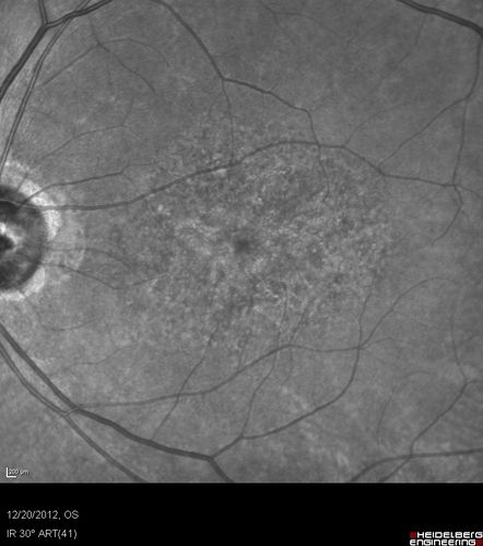 Non-specific (uncharaterized / unknown) Macular Dystrophy 
59-year-old man has macular dystrophy in both eyes.  He had some vision changes in medical school in the 1980s and saw Dr. Gass for that.  He had some pigment epithelial irregularities in both eyes.  He had strabismus as a child and had muscle surgery.  He is color blind, along with many people in his family, and as far as he knows, it is congenital.
20/25, 20/30
