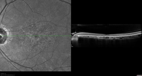 Non-specific (uncharaterized / unknown) Macular Dystrophy 
59-year-old man has macular dystrophy in both eyes.  He had some vision changes in medical school in the 1980s and saw Dr. Gass for that.  He had some pigment epithelial irregularities in both eyes.  He had strabismus as a child and had muscle surgery.  He is color blind, along with many people in his family, and as far as he knows, it is congenital.
20/25, 20/30
