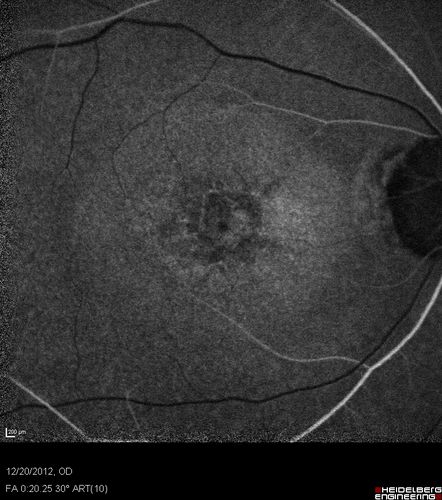 Non-specific (uncharaterized / unknown) Macular Dystrophy 
59-year-old man has macular dystrophy in both eyes.  He had some vision changes in medical school in the 1980s and saw Dr. Gass for that.  He had some pigment epithelial irregularities in both eyes.  He had strabismus as a child and had muscle surgery.  He is color blind, along with many people in his family, and as far as he knows, it is congenital.
20/25, 20/30
