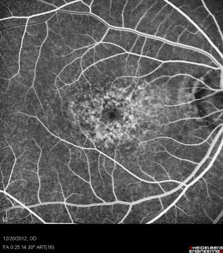 Non-specific (uncharaterized / unknown) Macular Dystrophy 
59-year-old man has macular dystrophy in both eyes.  He had some vision changes in medical school in the 1980s and saw Dr. Gass for that.  He had some pigment epithelial irregularities in both eyes.  He had strabismus as a child and had muscle surgery.  He is color blind, along with many people in his family, and as far as he knows, it is congenital.
20/25, 20/30
