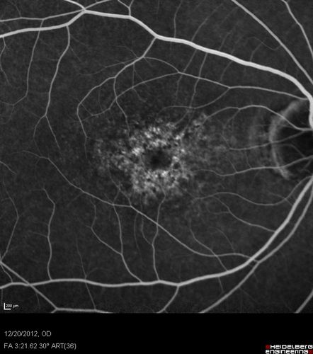 Non-specific (uncharaterized / unknown) Macular Dystrophy 
59-year-old man has macular dystrophy in both eyes.  He had some vision changes in medical school in the 1980s and saw Dr. Gass for that.  He had some pigment epithelial irregularities in both eyes.  He had strabismus as a child and had muscle surgery.  He is color blind, along with many people in his family, and as far as he knows, it is congenital.
20/25, 20/30
