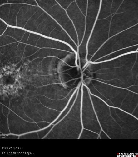 Non-specific (uncharaterized / unknown) Macular Dystrophy 
59-year-old man has macular dystrophy in both eyes.  He had some vision changes in medical school in the 1980s and saw Dr. Gass for that.  He had some pigment epithelial irregularities in both eyes.  He had strabismus as a child and had muscle surgery.  He is color blind, along with many people in his family, and as far as he knows, it is congenital.
20/25, 20/30
