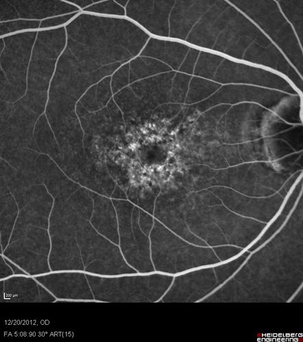 Non-specific (uncharaterized / unknown) Macular Dystrophy 
59-year-old man has macular dystrophy in both eyes.  He had some vision changes in medical school in the 1980s and saw Dr. Gass for that.  He had some pigment epithelial irregularities in both eyes.  He had strabismus as a child and had muscle surgery.  He is color blind, along with many people in his family, and as far as he knows, it is congenital.
20/25, 20/30
