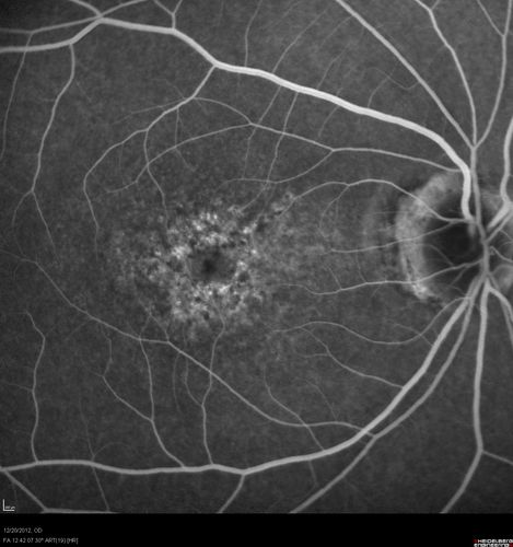 Non-specific (uncharaterized / unknown) Macular Dystrophy 
59-year-old man has macular dystrophy in both eyes.  He had some vision changes in medical school in the 1980s and saw Dr. Gass for that.  He had some pigment epithelial irregularities in both eyes.  He had strabismus as a child and had muscle surgery.  He is color blind, along with many people in his family, and as far as he knows, it is congenital.
20/25, 20/30
