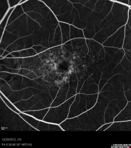 Non-specific (uncharaterized / unknown) Macular Dystrophy 
59-year-old man has macular dystrophy in both eyes.  He had some vision changes in medical school in the 1980s and saw Dr. Gass for that.  He had some pigment epithelial irregularities in both eyes.  He had strabismus as a child and had muscle surgery.  He is color blind, along with many people in his family, and as far as he knows, it is congenital.
20/25, 20/30
