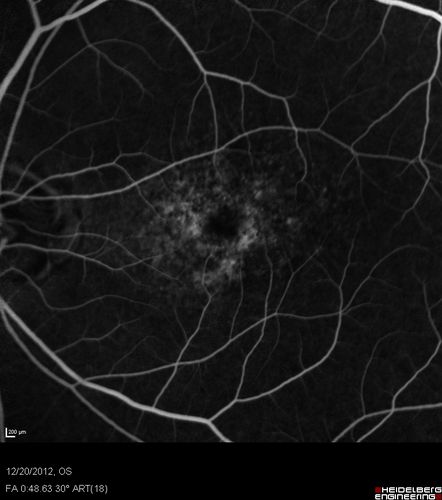 Non-specific (uncharaterized / unknown) Macular Dystrophy 
59-year-old man has macular dystrophy in both eyes.  He had some vision changes in medical school in the 1980s and saw Dr. Gass for that.  He had some pigment epithelial irregularities in both eyes.  He had strabismus as a child and had muscle surgery.  He is color blind, along with many people in his family, and as far as he knows, it is congenital.
20/25, 20/30
