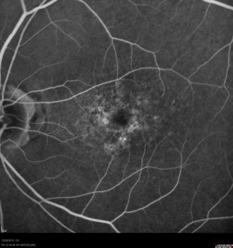 Non-specific (uncharaterized / unknown) Macular Dystrophy 
59-year-old man has macular dystrophy in both eyes.  He had some vision changes in medical school in the 1980s and saw Dr. Gass for that.  He had some pigment epithelial irregularities in both eyes.  He had strabismus as a child and had muscle surgery.  He is color blind, along with many people in his family, and as far as he knows, it is congenital.
20/25, 20/30
