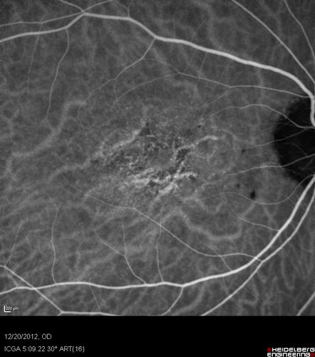Non-specific (uncharaterized / unknown) Macular Dystrophy - ICG
59-year-old man has macular dystrophy in both eyes.  He had some vision changes in medical school in the 1980s and saw Dr. Gass for that.  He had some pigment epithelial irregularities in both eyes.  He had strabismus as a child and had muscle surgery.  He is color blind, along with many people in his family, and as far as he knows, it is congenital.
20/25, 20/30
