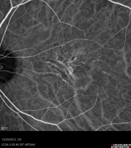 Non-specific (uncharaterized / unknown) Macular Dystrophy - ICG
59-year-old man has macular dystrophy in both eyes.  He had some vision changes in medical school in the 1980s and saw Dr. Gass for that.  He had some pigment epithelial irregularities in both eyes.  He had strabismus as a child and had muscle surgery.  He is color blind, along with many people in his family, and as far as he knows, it is congenital.
20/25, 20/30
