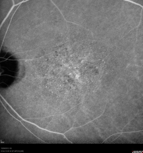 Non-specific (uncharaterized / unknown) Macular Dystrophy - ICG
59-year-old man has macular dystrophy in both eyes.  He had some vision changes in medical school in the 1980s and saw Dr. Gass for that.  He had some pigment epithelial irregularities in both eyes.  He had strabismus as a child and had muscle surgery.  He is color blind, along with many people in his family, and as far as he knows, it is congenital.
20/25, 20/30
