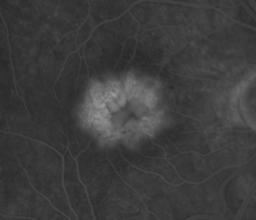 Idiopathic Cystoid Macular Edema - CME - Close up of Late Fluorescein Angiogram Showing Leakage into Foveal Cysts
49-year-old man had a flu two weeks ago the right eye has been throbbing and his vision in the right eye has been foggy.  OD 20/80, OS 20/40.   IOP:  14 OU.  

Keywords: cme;cystoid macular edema;steroids;idiopathic;best macular acquired