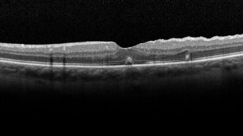 Macular fold - resolved with time
