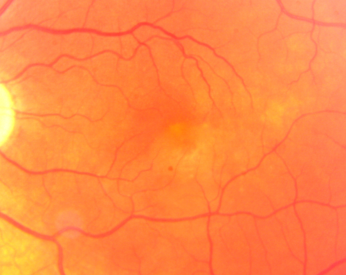 Wet AMD 62 year old male smoker 
62-year-old man has wet age-related macular degeneration in the right eye.  He has been undergoing treatment with Lucentis for that.  Then his left eye developed hazy vision a few weeks ago while he was overseas and now his vision is hazy in both eyes.   OD 20/40, OS 20/30.    FA shows a classic subfoveal choroidal neovascular membrane in the left eye, which is leaking and in the right eye, which is dry. He is going to stop smoking today. FU: VA 20/30 OU with 2 years of every 6 weeks bilateral avastin!
Keywords: wet amd; smoker; avastin; bilateral