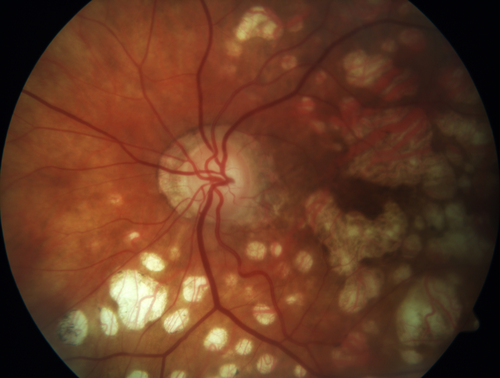 Macular Laser Scars
86 year old man who had Laser done from 2010 - 2018 for diabetic retinopathy.  The right eye lost vision immediately after laser was done a few years ago.  VA 1/200 OD; 20/25 OS

