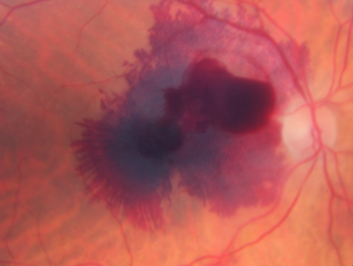 Ruptured Retinal Arterial Macroaneurysm - Submacular Hemorrhage - Vision 20/400 never recovered - Hypertension 205/94
