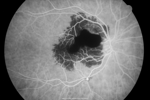 Ruptured Retinal Arterial Macroaneurysm - Submacular Hemorrhage - Vision 20/400 never recovered - Hypertension 205/94

